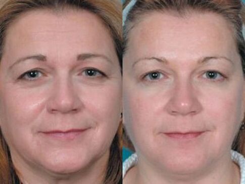nuotraukos prieš ir po odos atjauninimo plazmoje