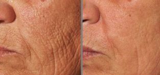 nuotrauka prieš ir po dalinio odos atnaujinimo