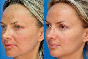 nuotrauka prieš ir po odos atnaujinimo prietaisu